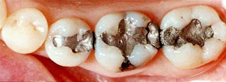 銀歯と白い歯の違いは？