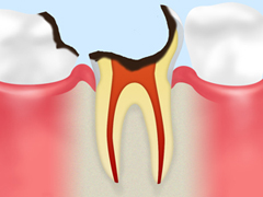 C4　歯根まで冒された末期の虫歯