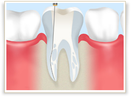歯の根の治療はとても大切です――根管治療について――
